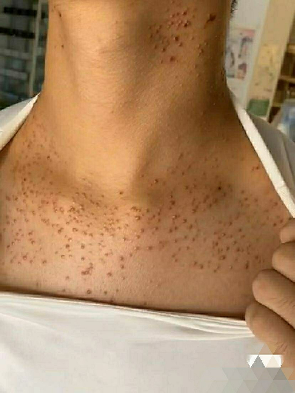 糠秕孢子菌毛囊炎快好了,真开心97