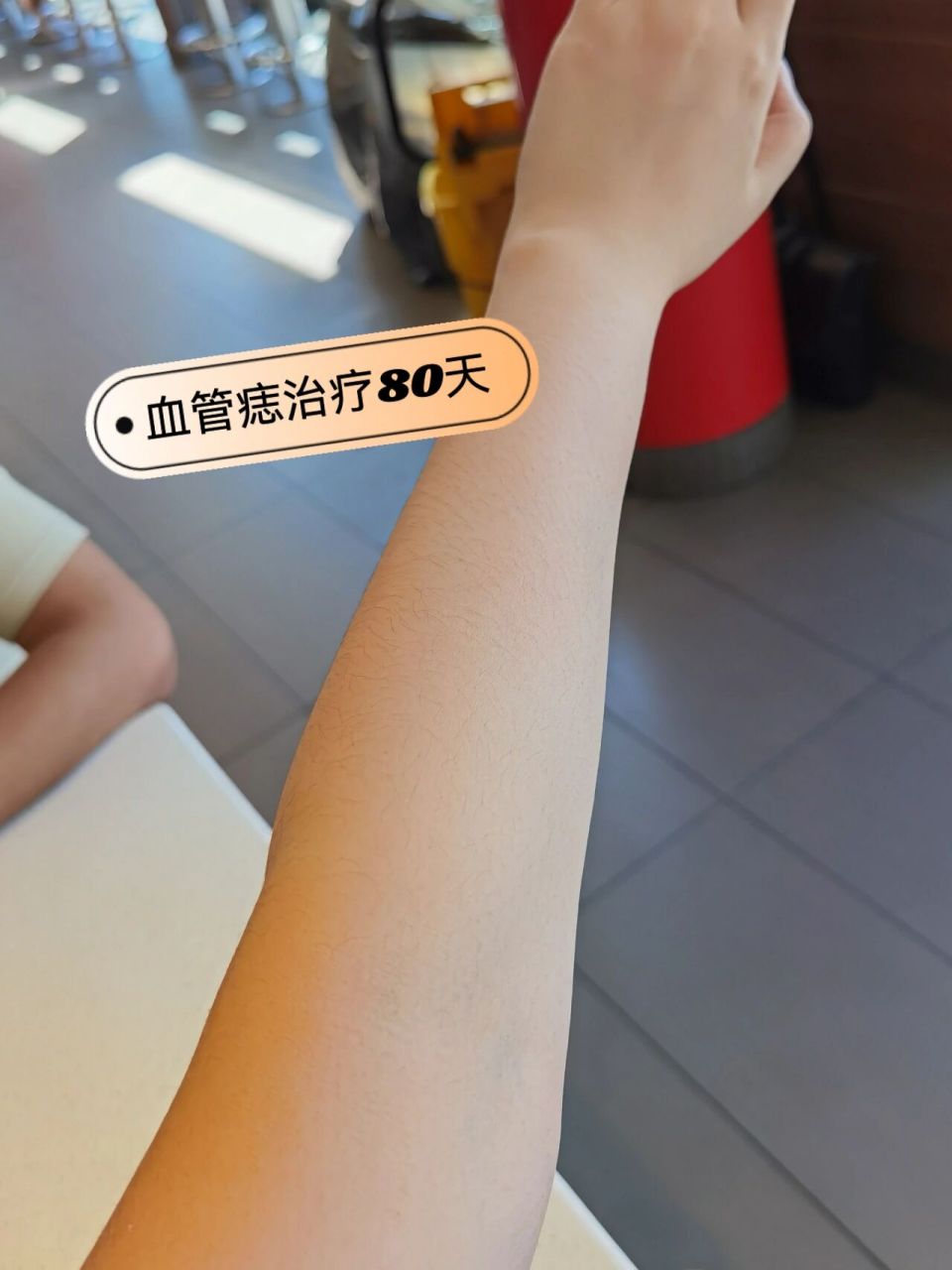 小红点血管痣 给你们后续看看 治疗80天后的效果 本人很是满意04