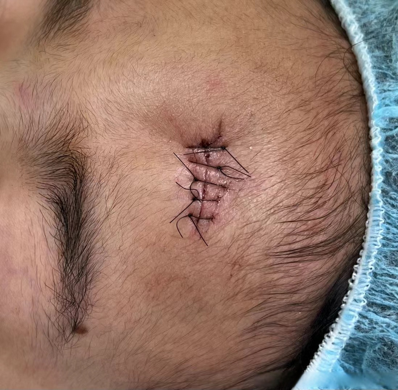 昨晚额头摔伤的小女生急诊缝合后,妈妈担心疤痕,想要美容缝合托朋友