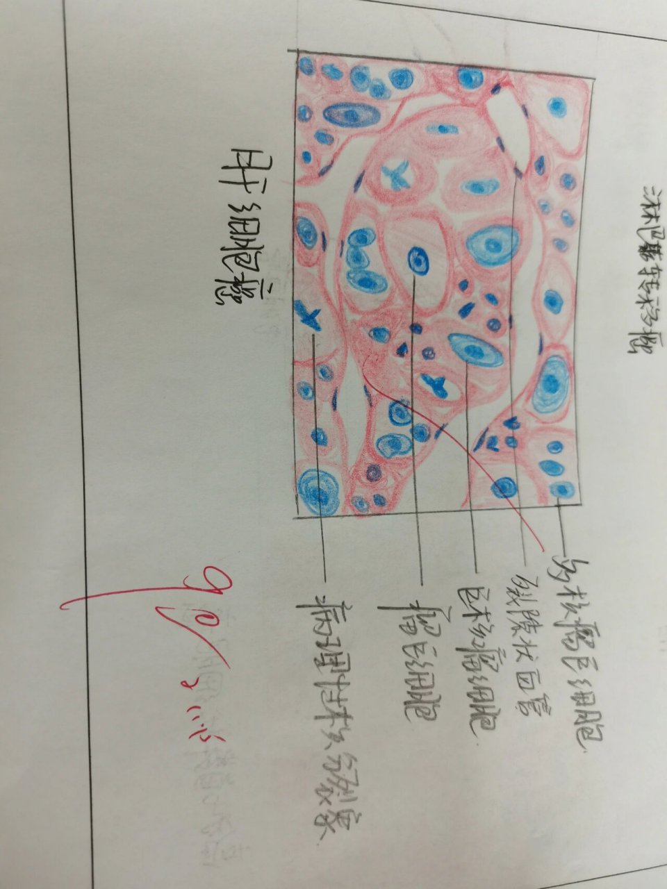 病理肿瘤红蓝铅笔图 皮肤乳头状瘤 高分化鳞状细胞癌 淋巴结转移癌