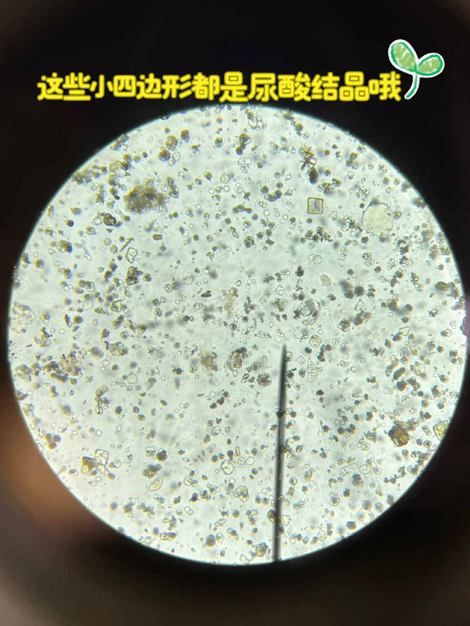 嘘嘘里面的结晶之磷酸铵镁结晶和尿酸结晶     	 先说磷酸铵镁结晶吧