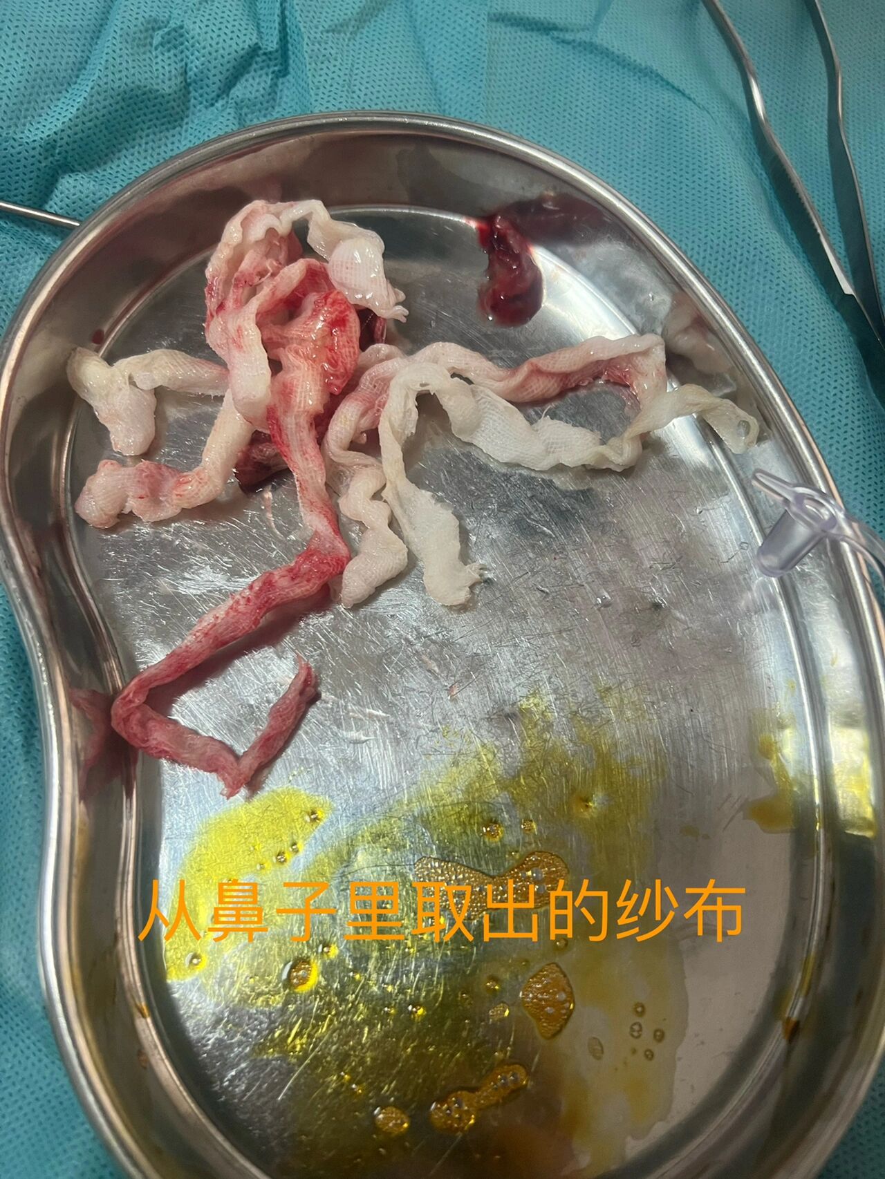 鼻息肉切除手术分享 医生开住院条的那天把入院前的检查都给我开了,有