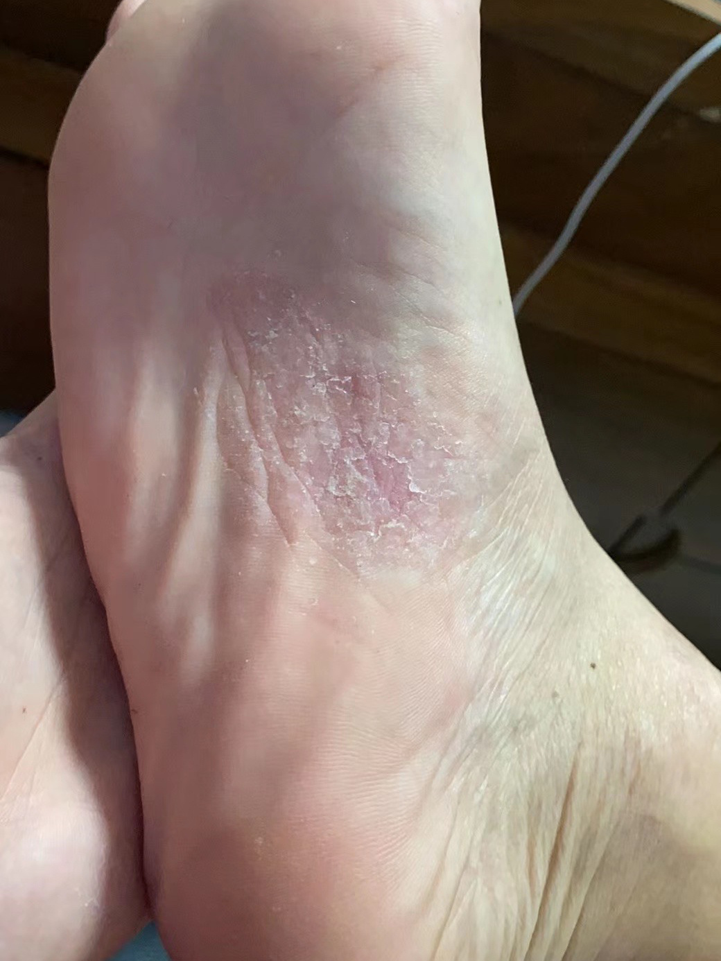 香港脚的症状十分多样化,并非全部的香港脚都有臭味,容易发生脚臭的