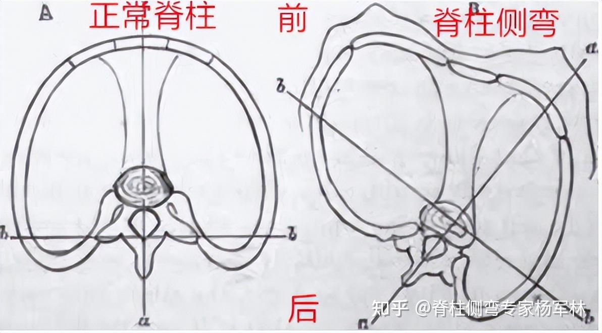 警惕破坏美感的剃刀背可能是脊柱侧弯引起的