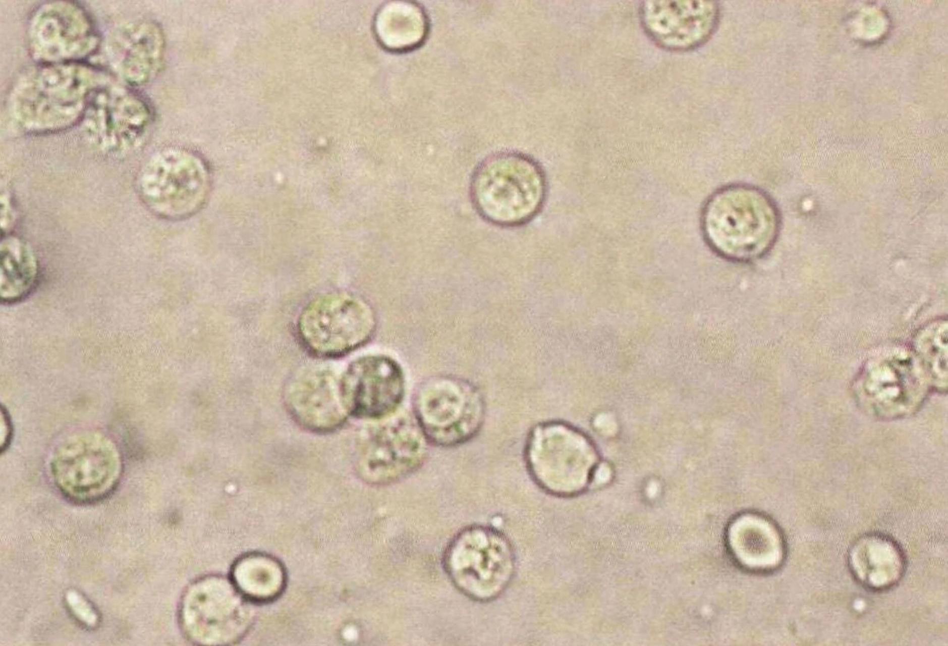 检验高频考点之尿液细胞图谱(六)中性粒细胞 尿中白细胞多以中性粒