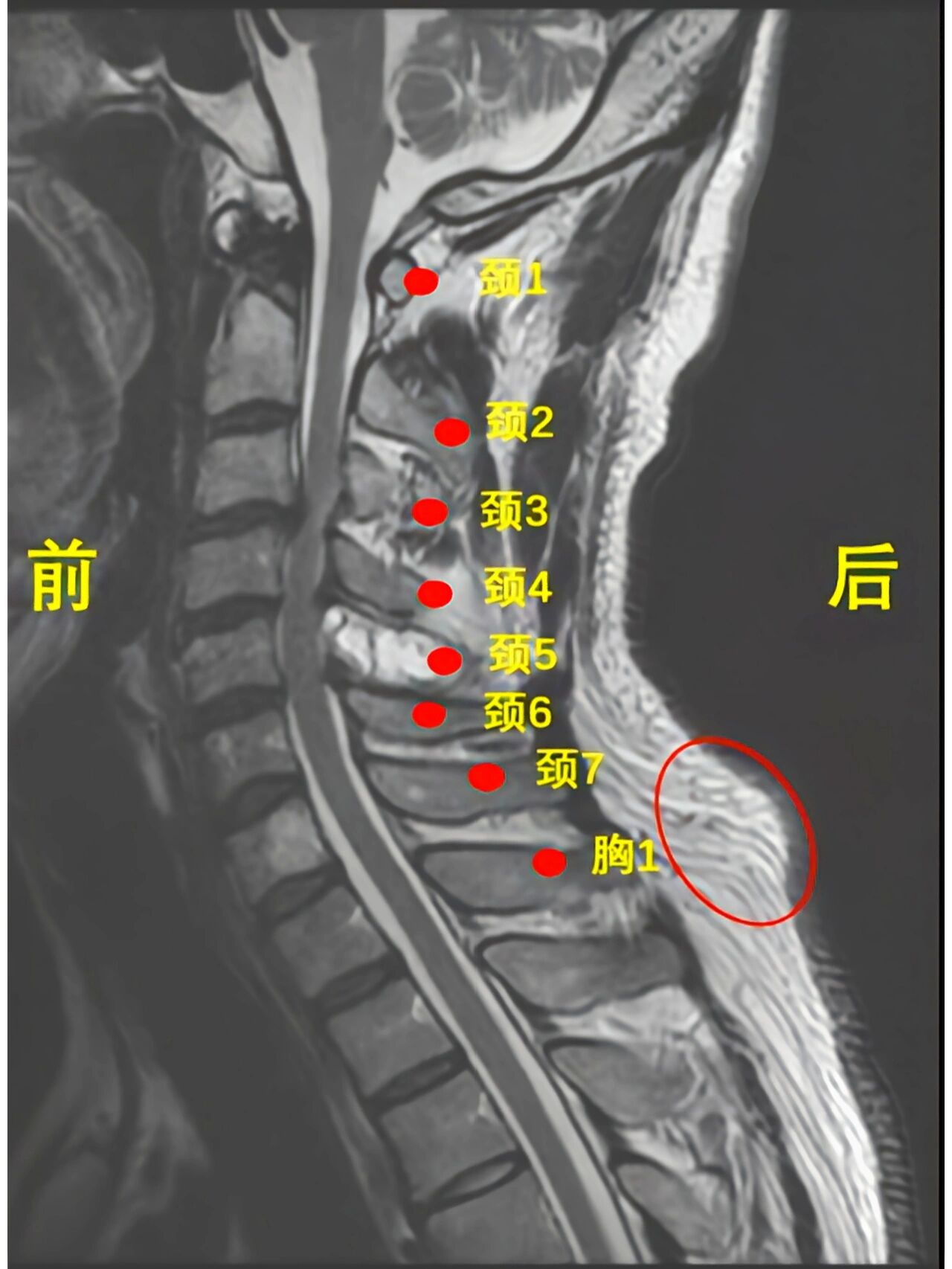 该如何是好呢 很多人患上颈椎病后不知道如何治疗