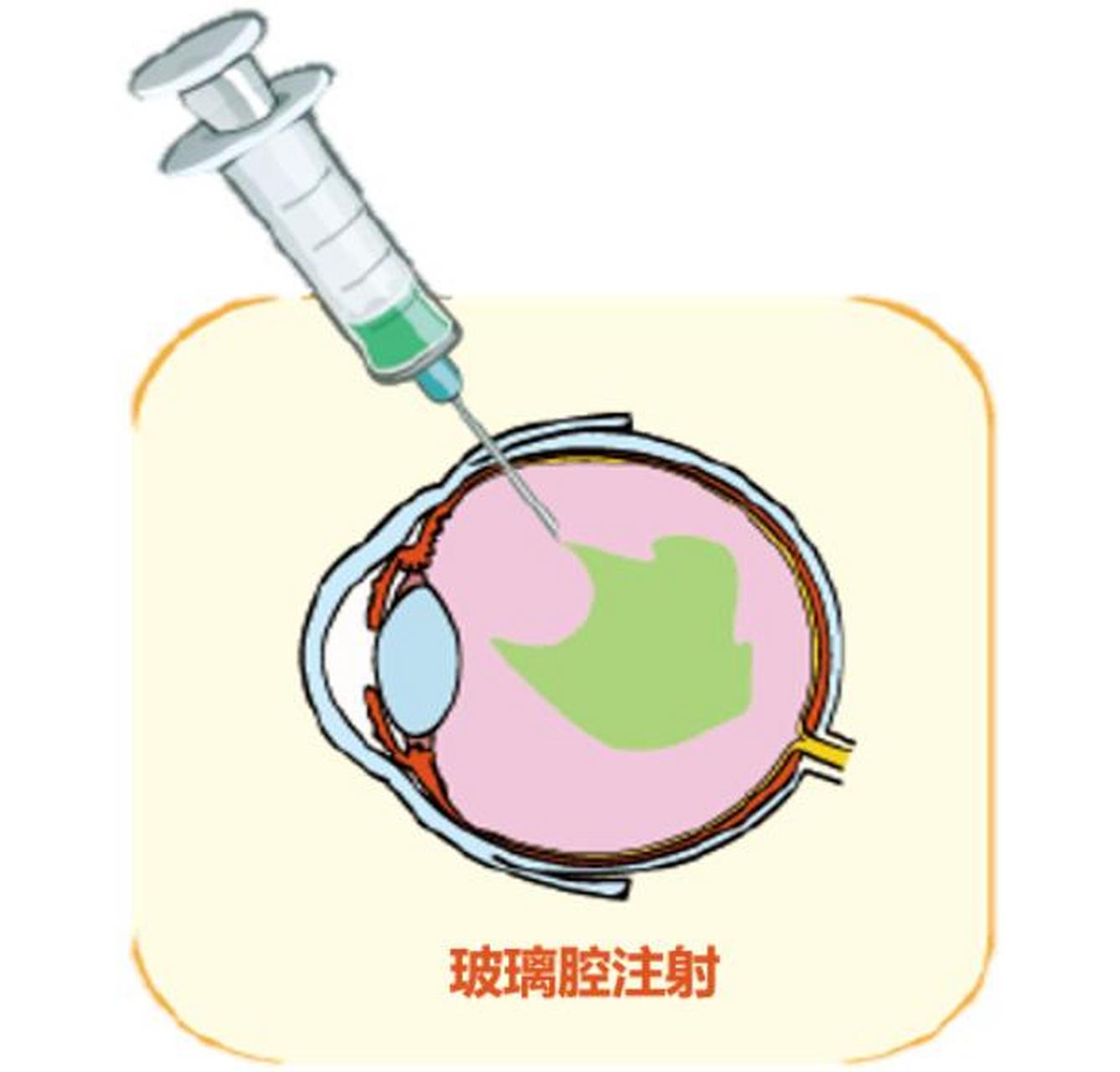 黄斑水肿打完针后 多久才能消肿 我来告诉你  黄斑水肿打针后多久才能