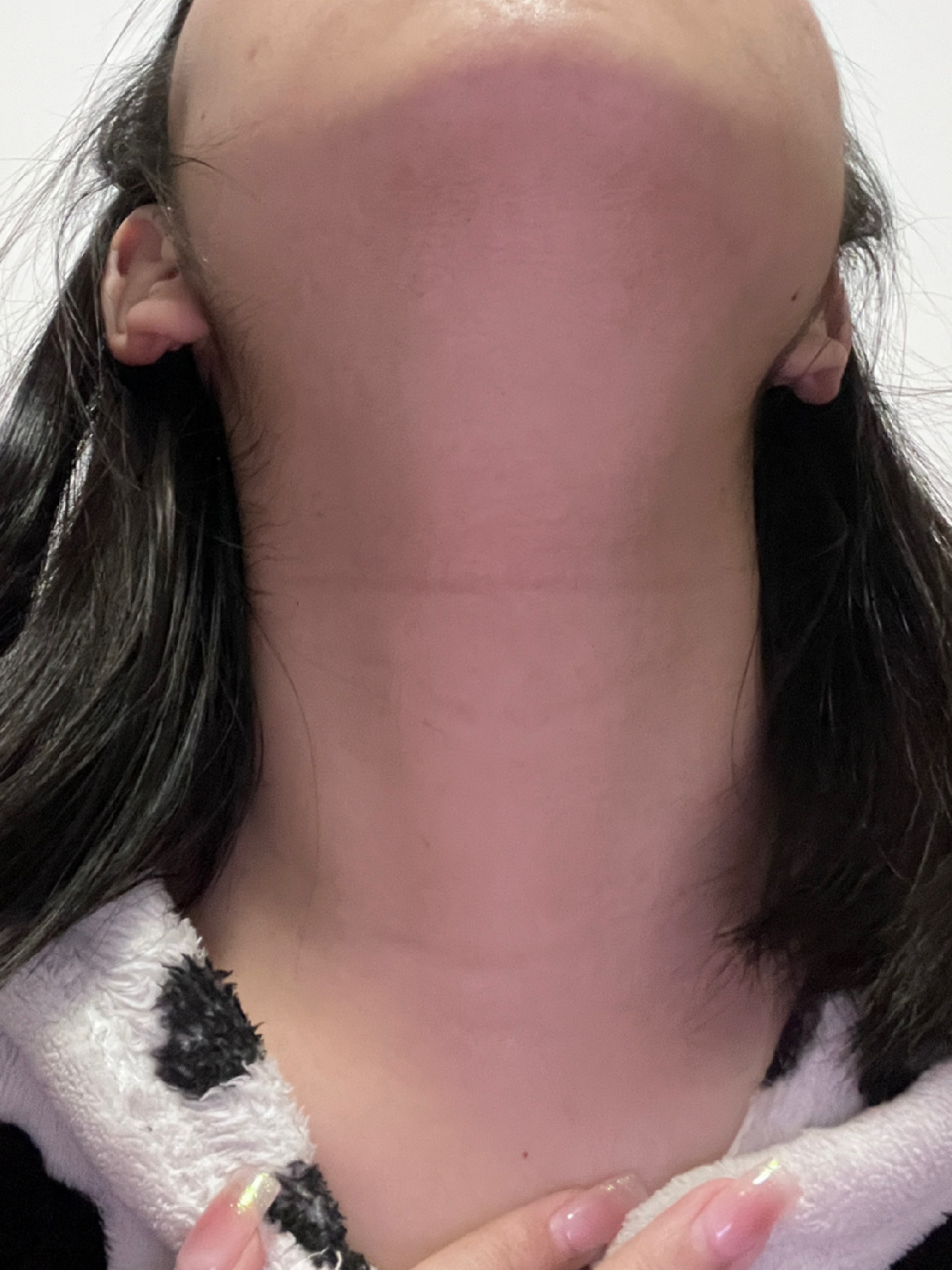 这是甲亢吗? 突然发现脖子有凸起,不会痛,也没啥感觉.这是正常的吗?