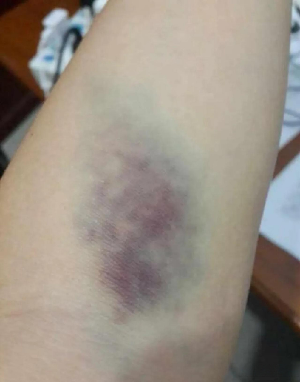 女子20元拔罐除湿拔出黑紫色拔罐的时候,毛细血管破裂,毛细血管网里有