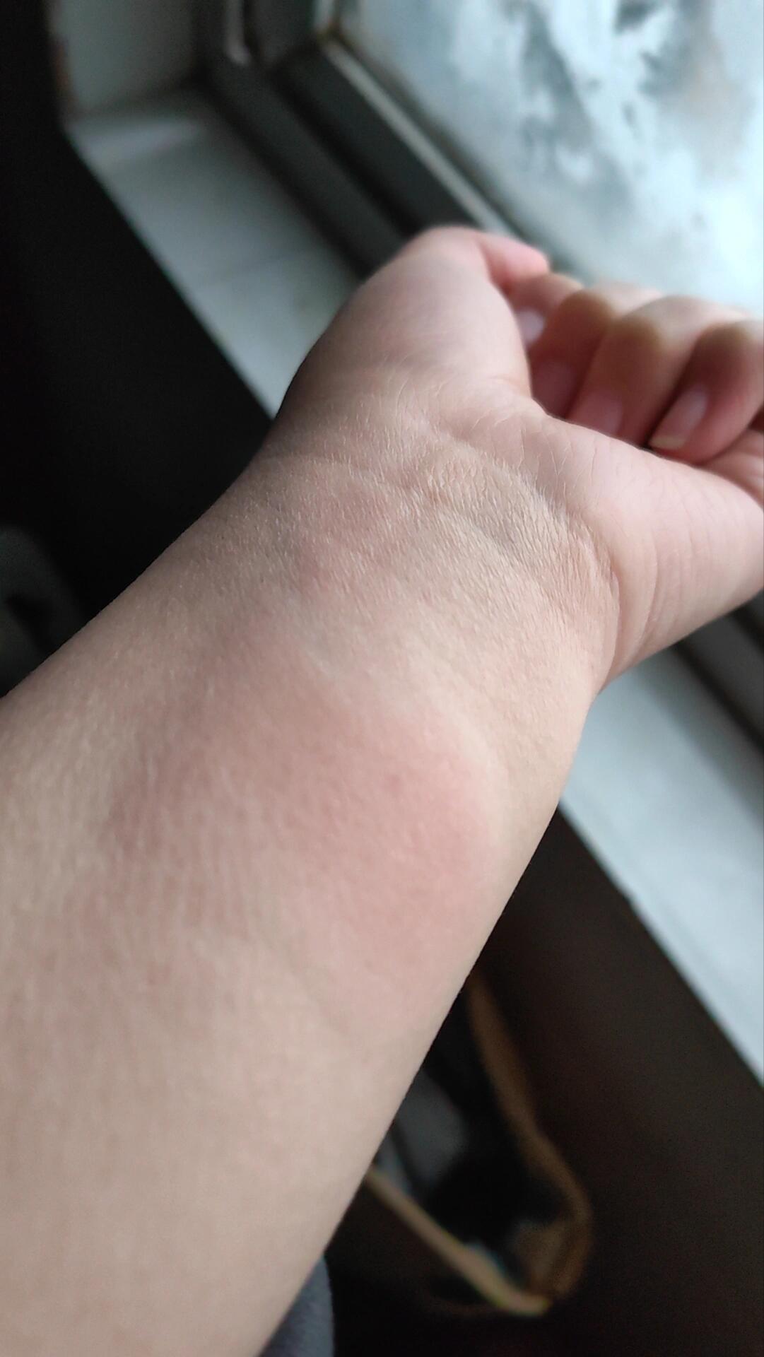 皮试48h内过敏反应过程 肺结核皮试过敏!好难受!