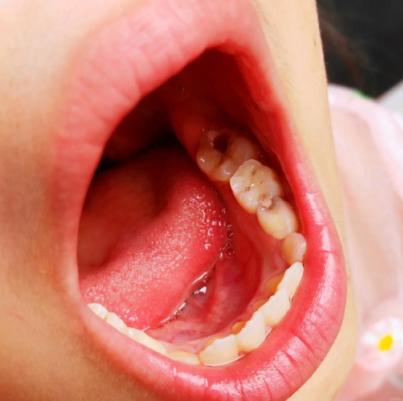 这是因为平时口腔清洁不够,细菌长期破坏牙齿硬组织造成的