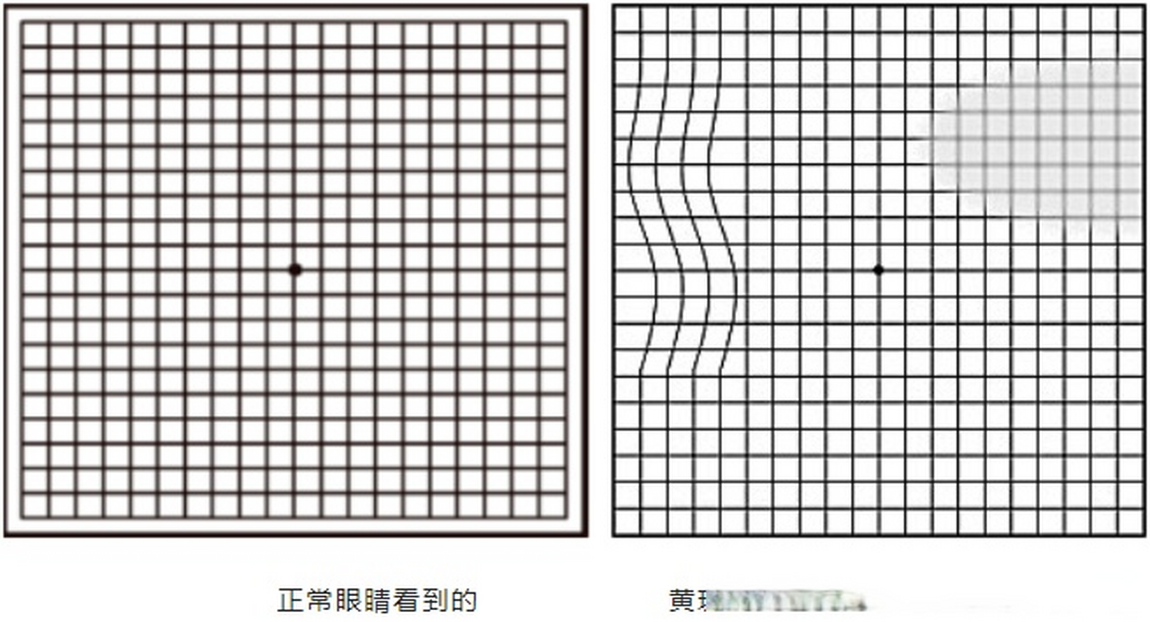 黄斑病测试图图片