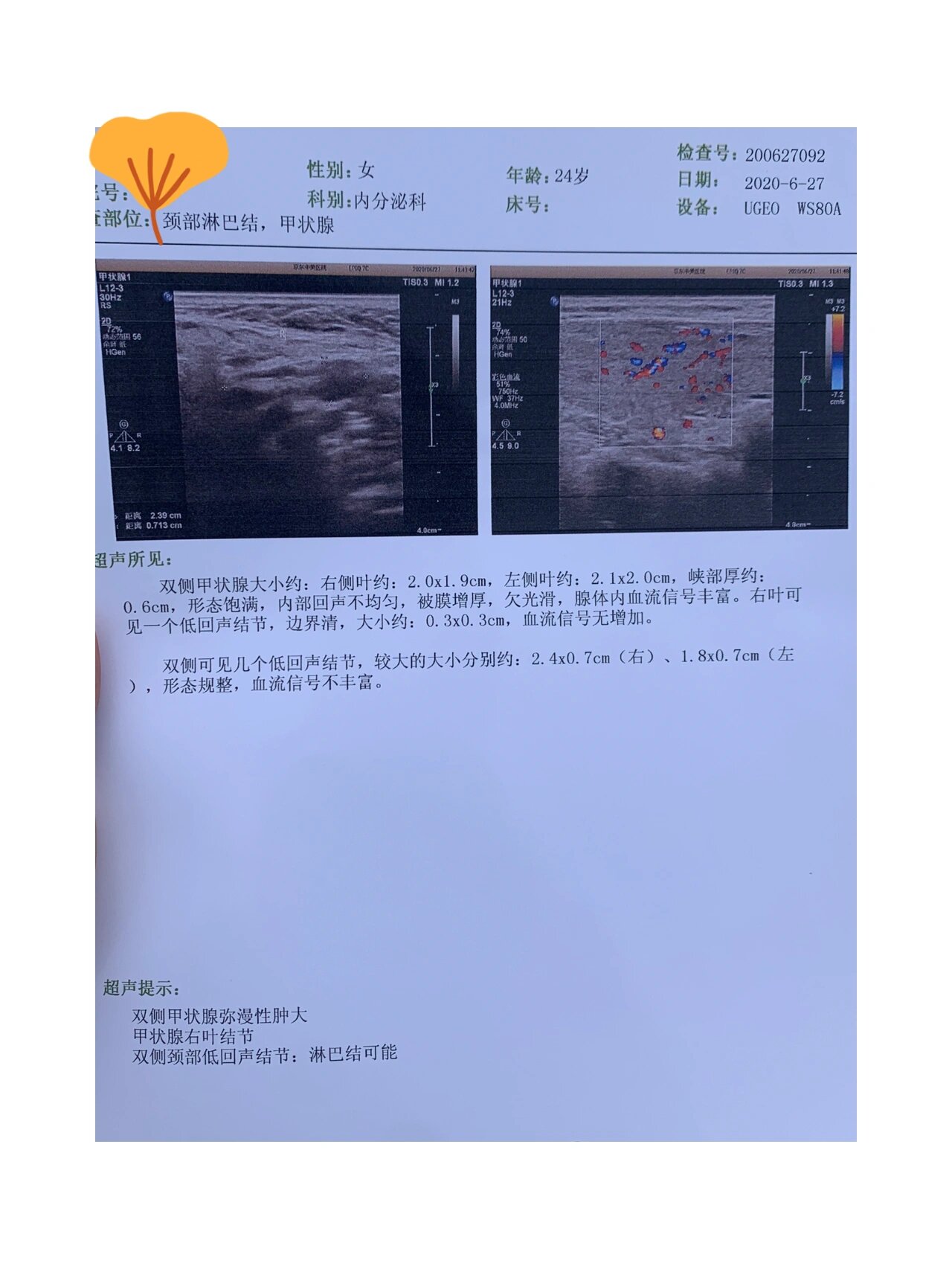 甲状腺弥漫性肿大