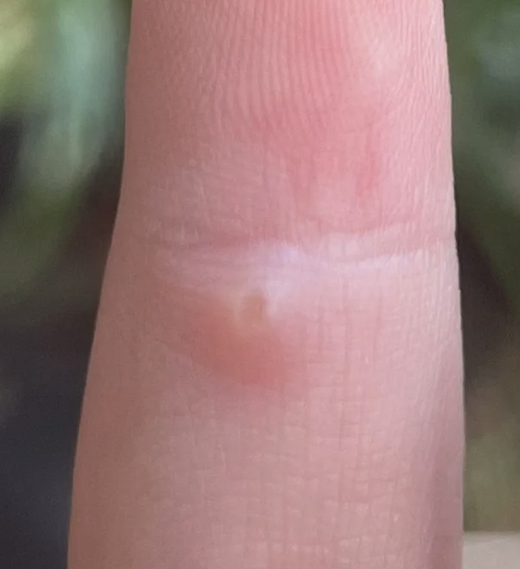 手指头上长个硬疙瘩但不痛不痒,常见的原因有胼胝,寻常疣或皮脂腺