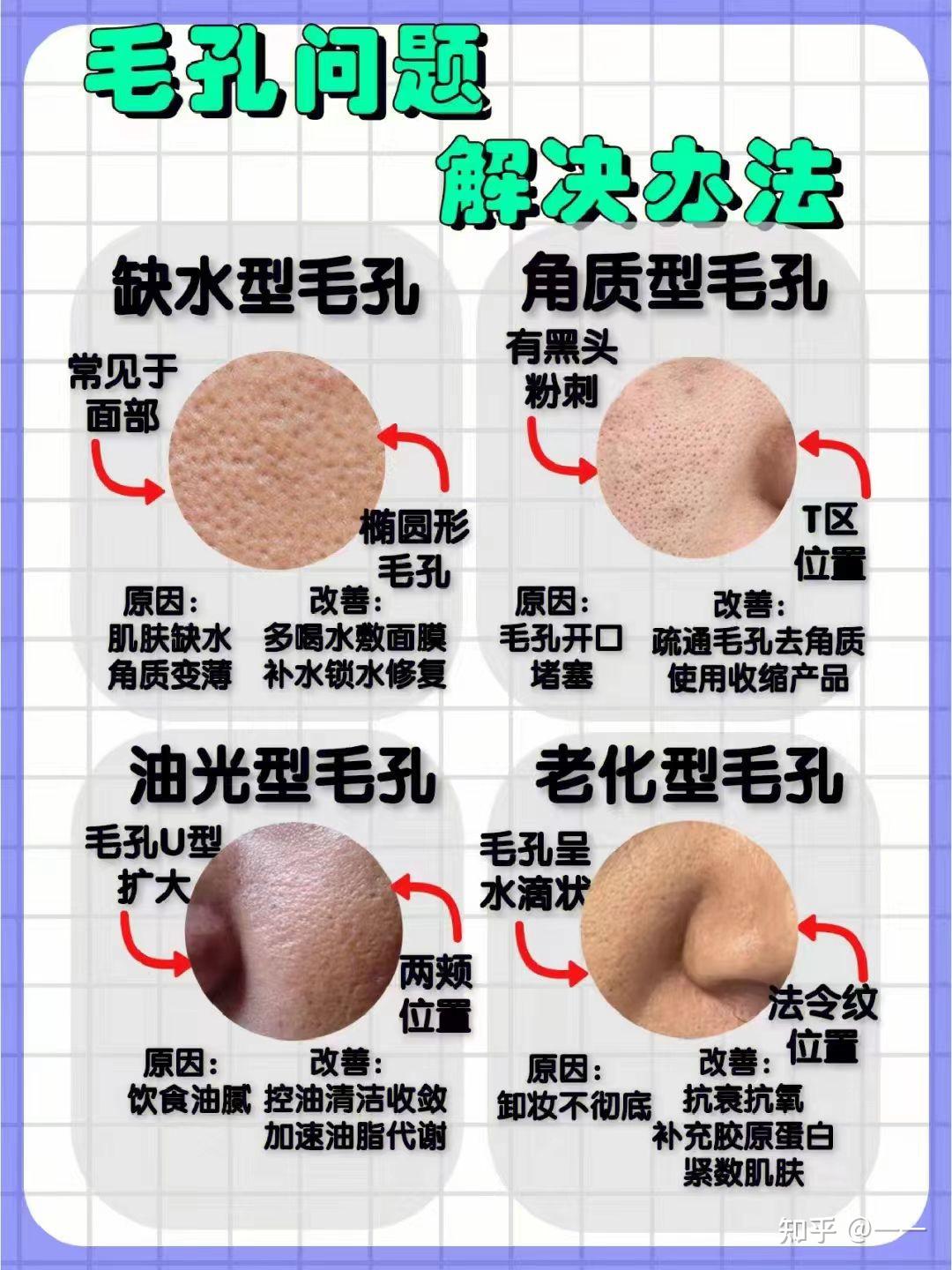 额头毛孔粗大有黑头怎么处理