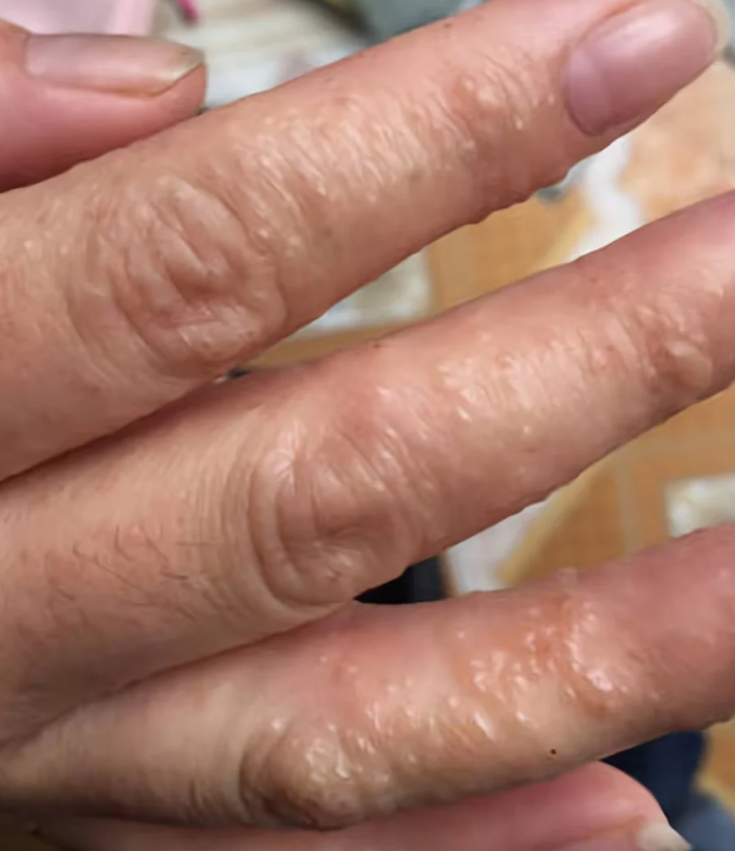 汗疱疹如果聚集成大水疱,通常是病情加重的表现