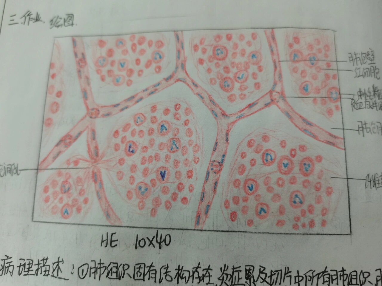 肺水肿绘图图片