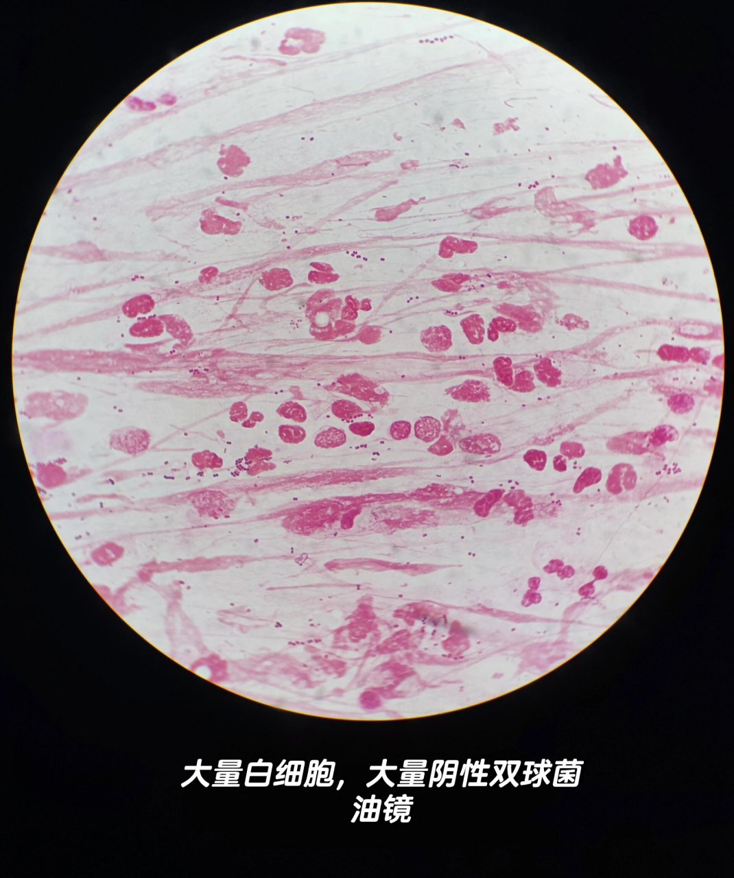 卡他莫拉菌 2岁女童,发热4天,咳嗽一周,诊断支气管肺炎.