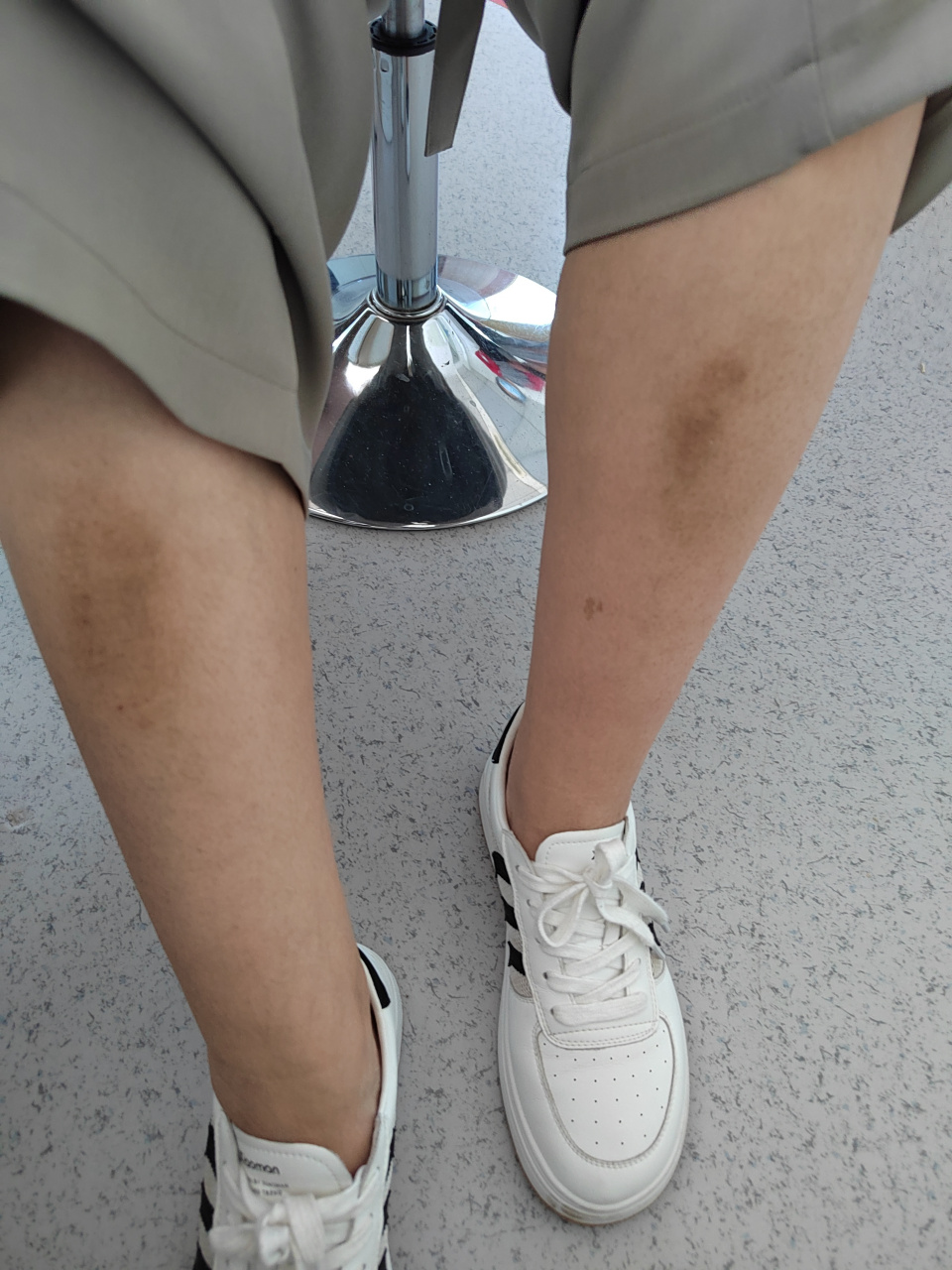 小腿胫前的色素沉着过度和皮肤粗糙症状.考虑淤积性皮炎可能.