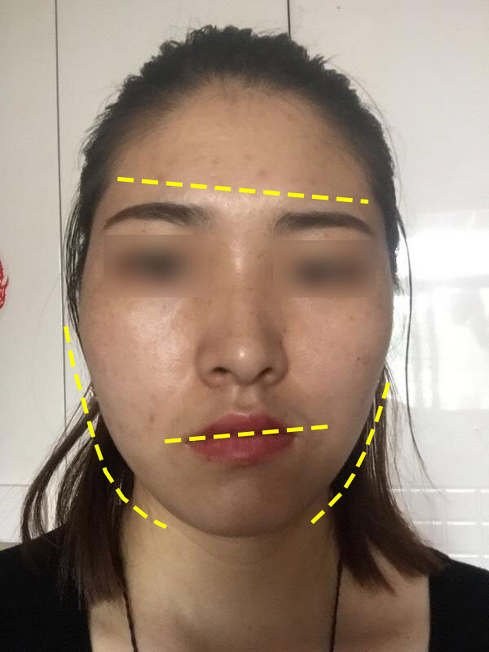 导致大小脸真的只是因为单侧睡觉,咀嚼吗?