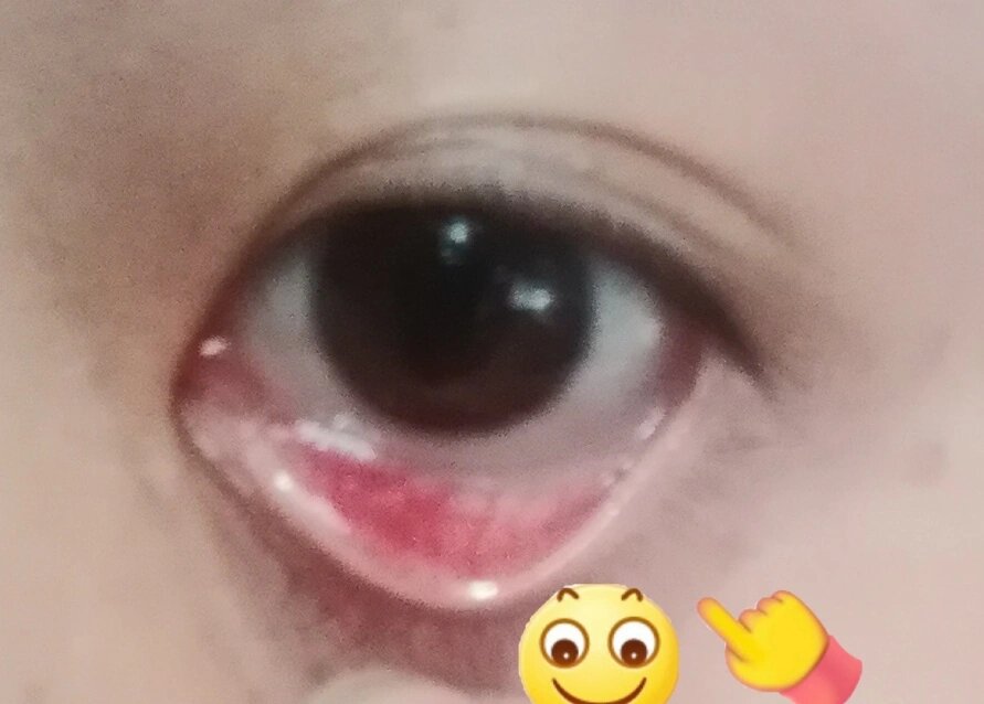 戴美瞳戴的眼睛好疼 怎么办啊家人们