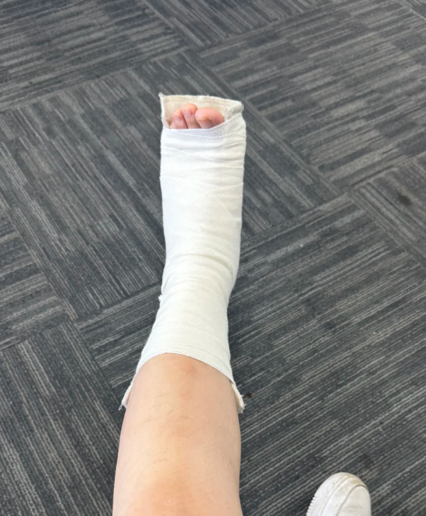 骨折是常见的外伤,患者会出现局部疼痛,肿胀,畸形和活动受限