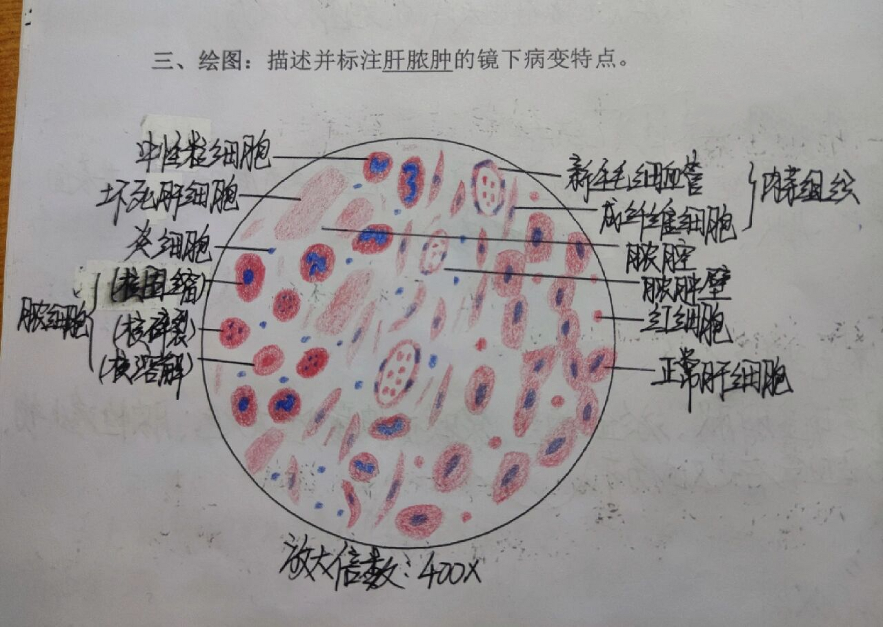病理学红蓝铅笔绘图(全) ①肾近曲小管上皮细胞水肿 ②肺动脉内混合