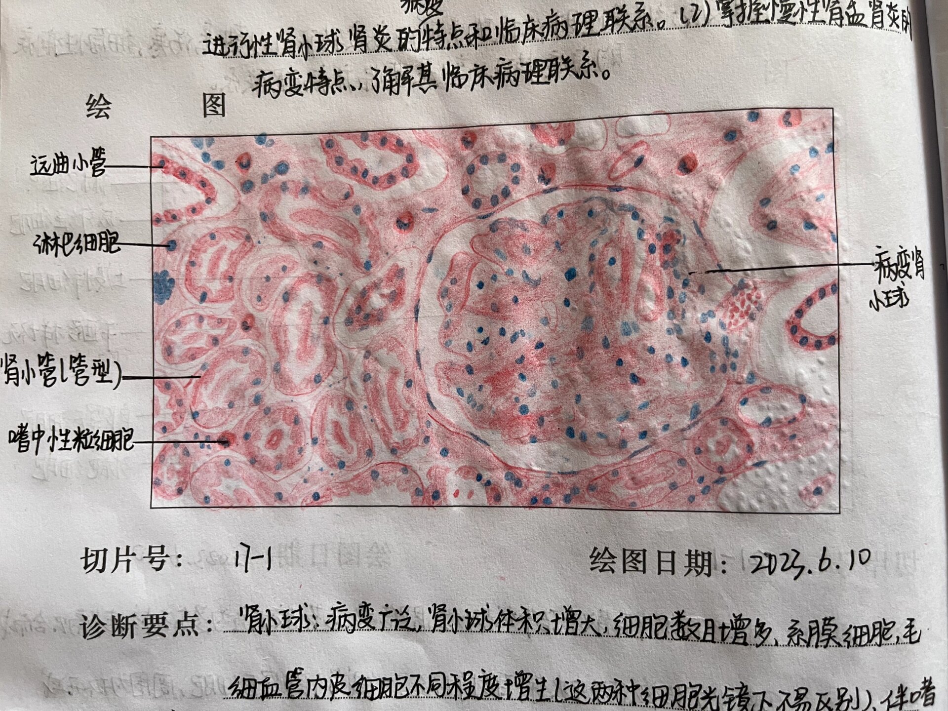 慢性肾炎红蓝铅笔绘图图片