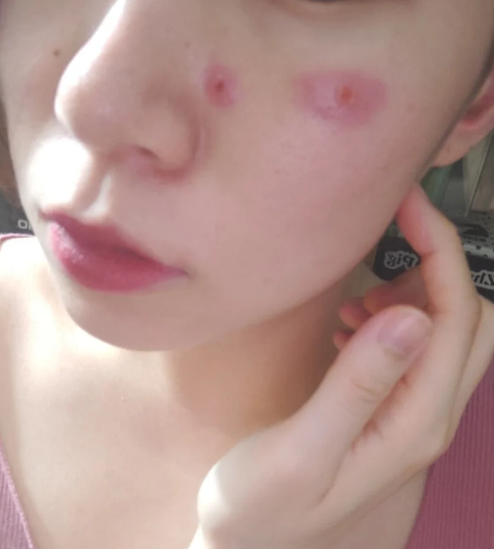 脸上长疱疹最常见的原因是单纯疱疹,带状疱疹和天疱疮这三种情况