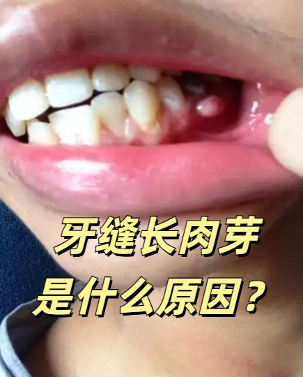 牙缝长肉芽是什么原因?