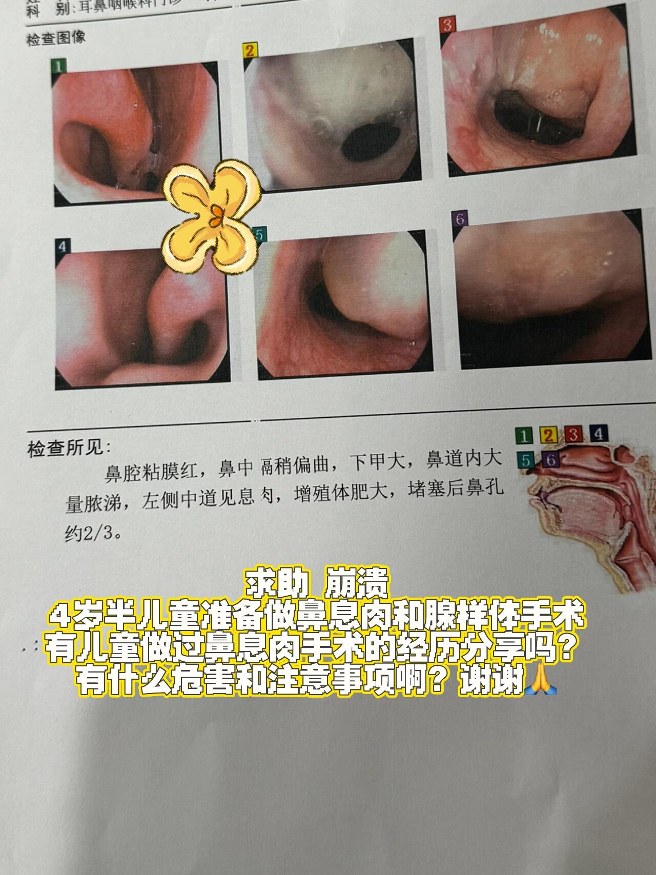 鼻息肉切除手术多少钱图片