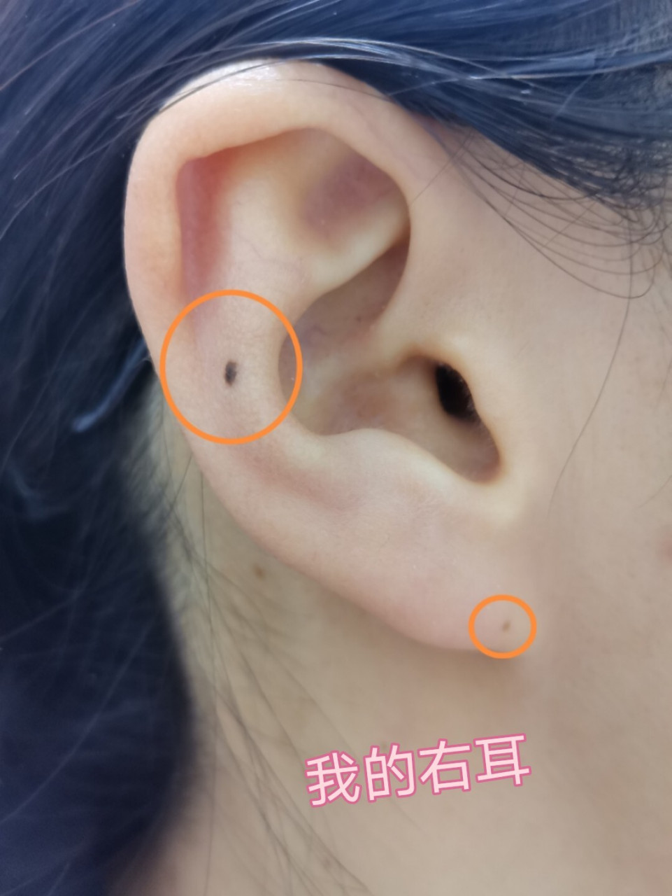 大致分为以下几种解析:耳轮有痣,聪明;耳廓有痣,长寿;耳垂有痣,钱财