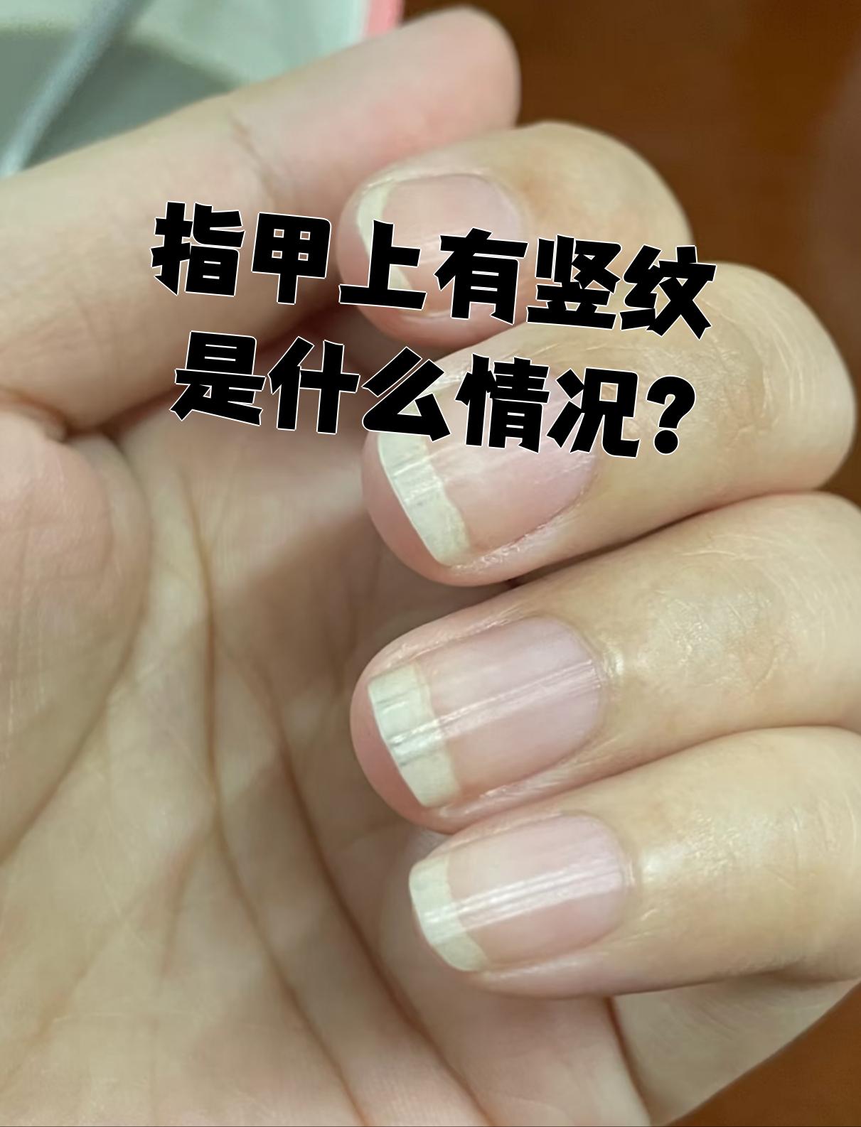指甲上有竖纹是什么情况?