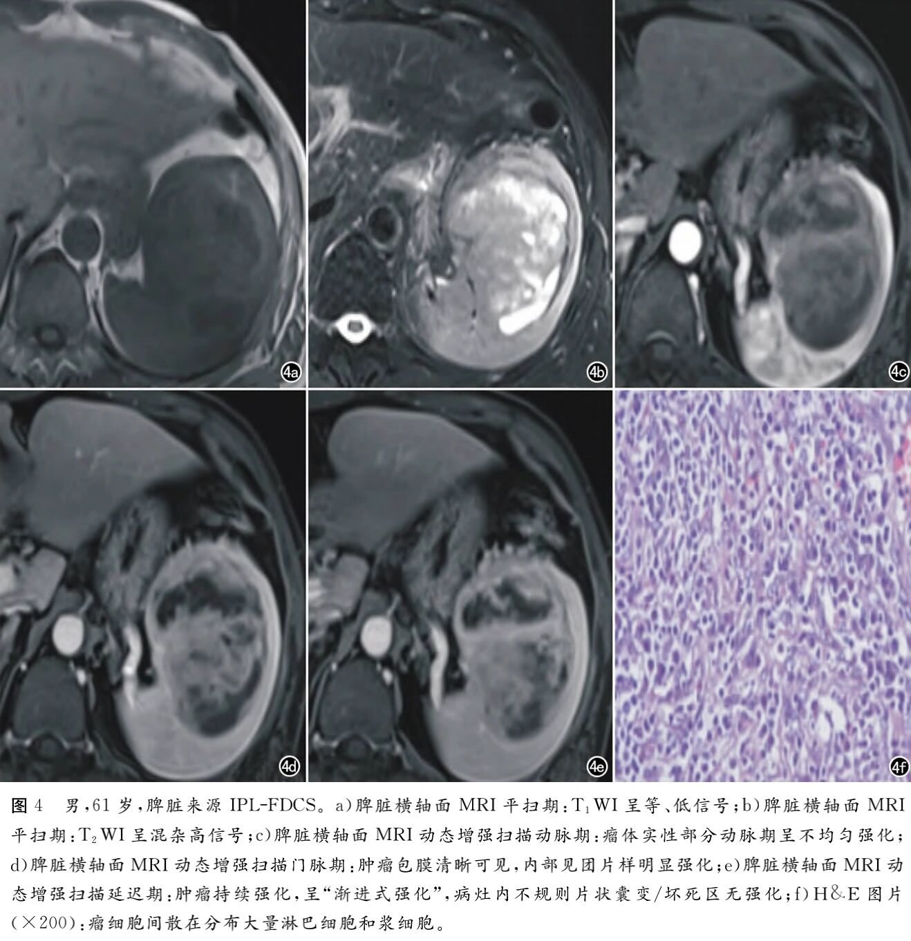 腹部滤泡树突细胞肉瘤的影像学表现