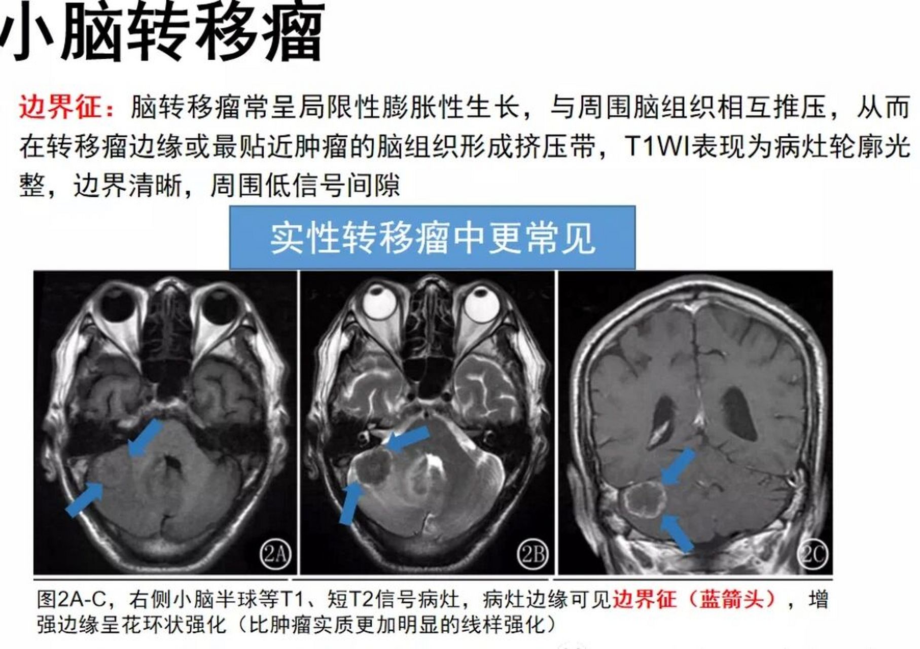 小脑蚓部髓母细胞瘤图片