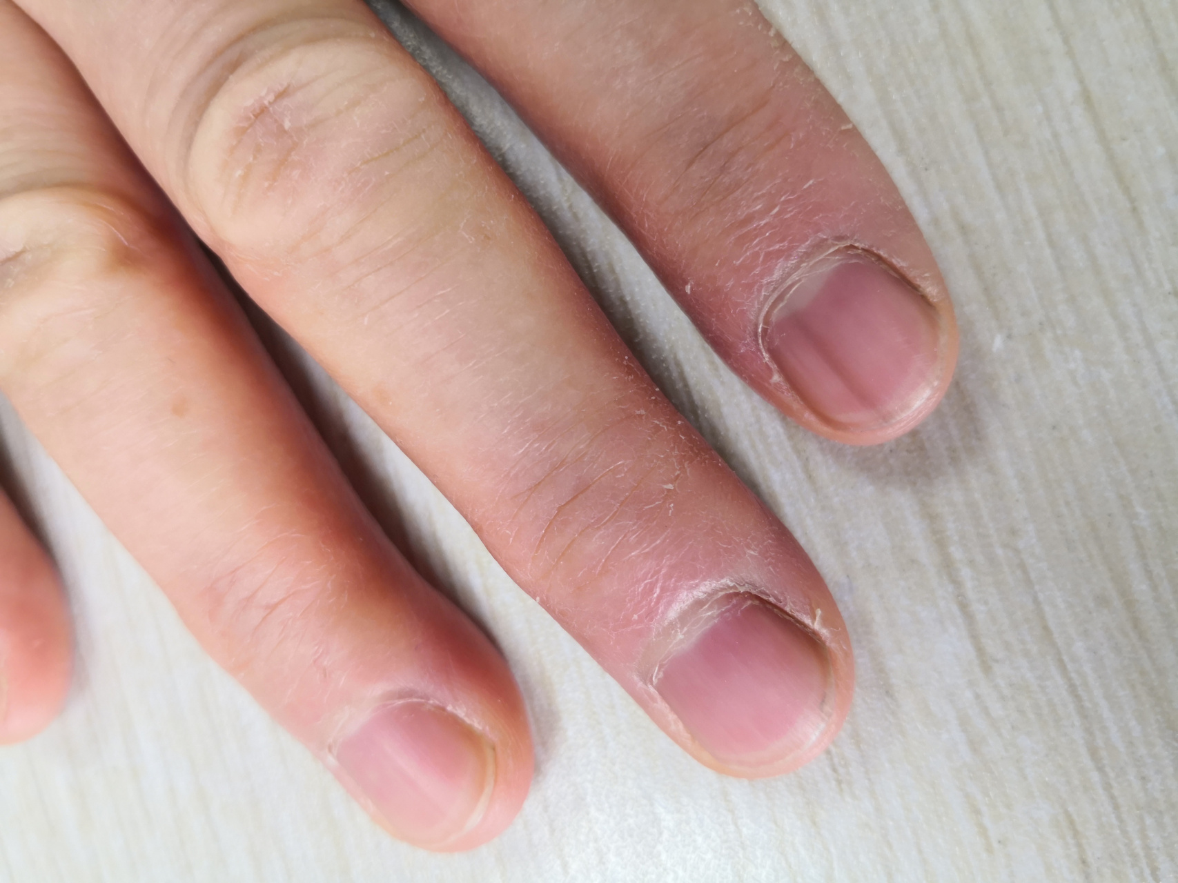 甲黑线#甲母痣# 可以观察#灰指甲