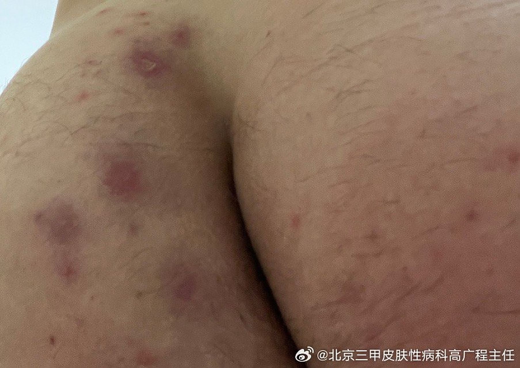 微博健康公开课# 屁股上长痘痘,我想看一下是不是梅毒?