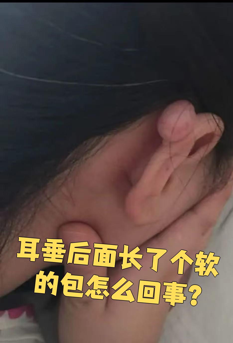 耳垂后面摸到软包块,常见原因有三种:淋巴结,皮脂腺囊肿和脂肪瘤