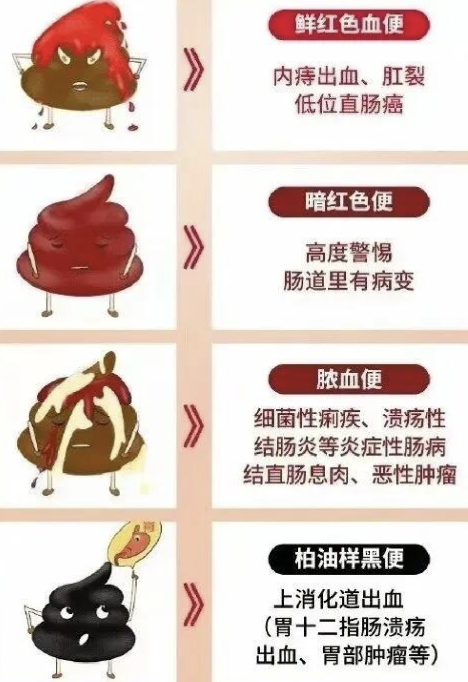 正常健康的大便应该是香蕉那样的黄色,形状是长条形的软便