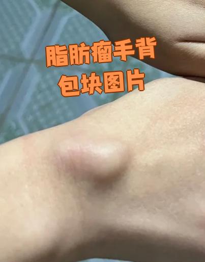 脂肪瘤手背包块图片