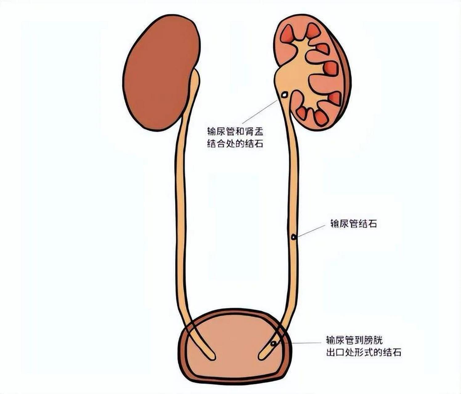 输尿管走形图片图片