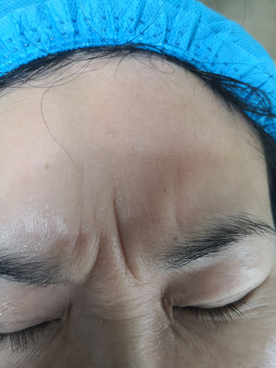 眉间纹眼角纹抬头纹鼻背纹.使用肉毒素注射除皱能够达到比较好的美容