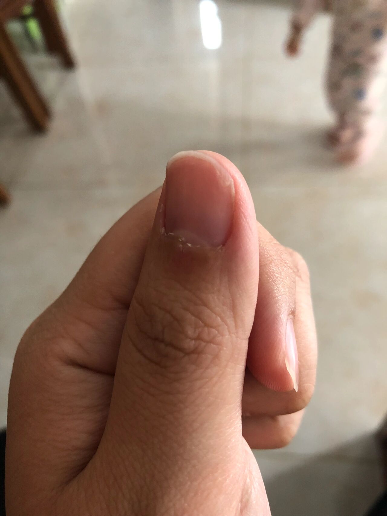 指甲与甲床分离 亲们,最近一个月突然发现两只手的大拇指指甲与甲床