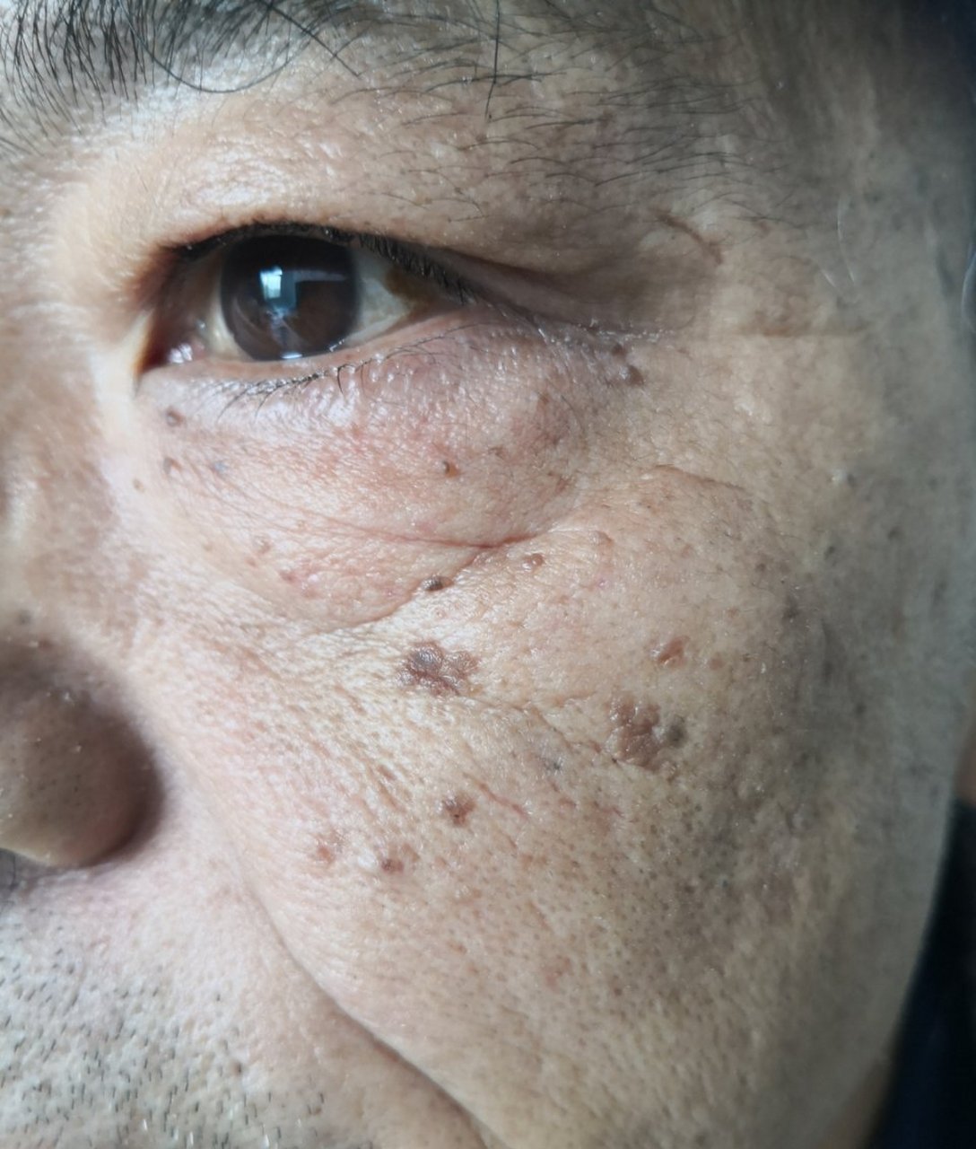 面部外伤后色素沉着过度症状和面部老年斑/脂溢性角化.