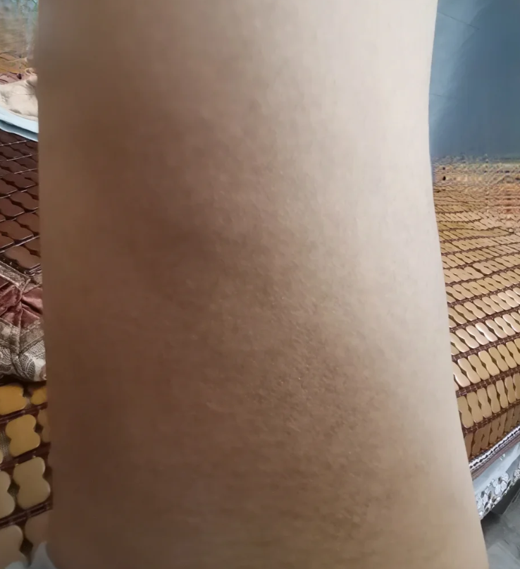 腋下和大腿根内侧发黑可能是正常情况,也可能是黑棘皮病等问题引起