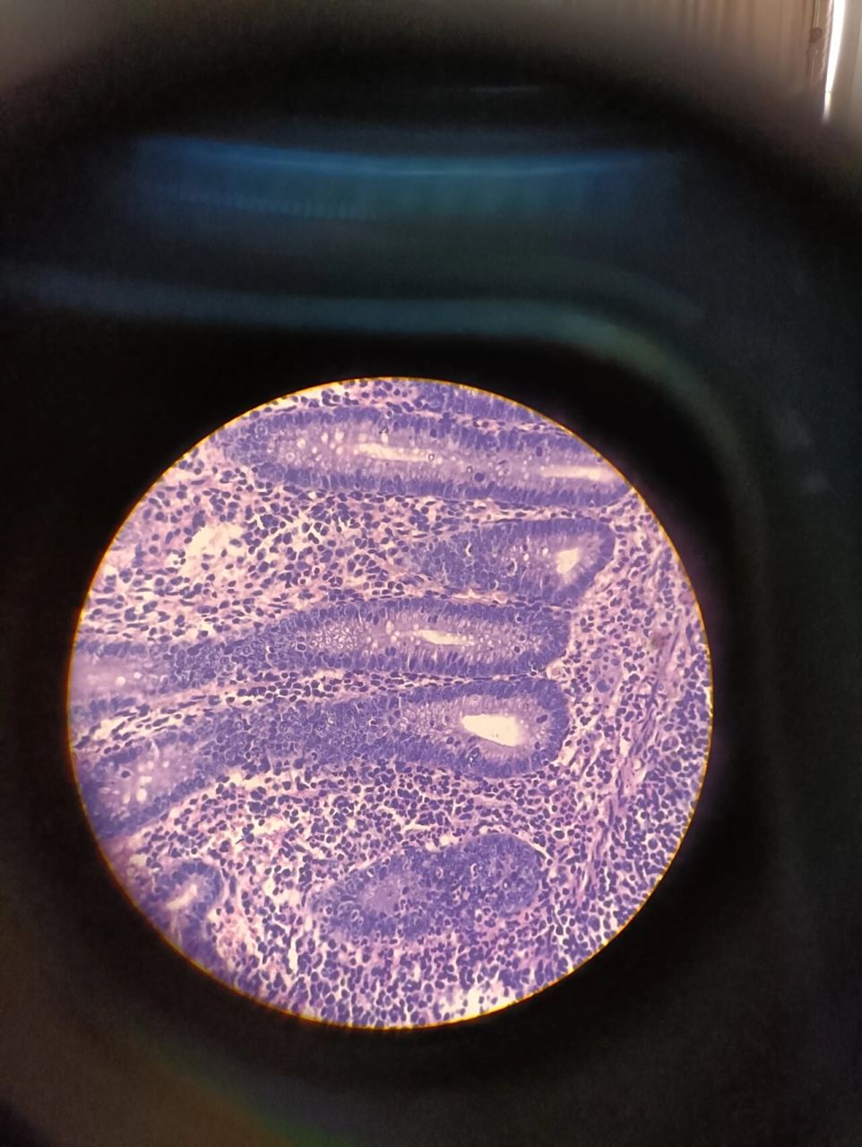 4急性蜂窝织性阑尾炎 p5肺脓肿