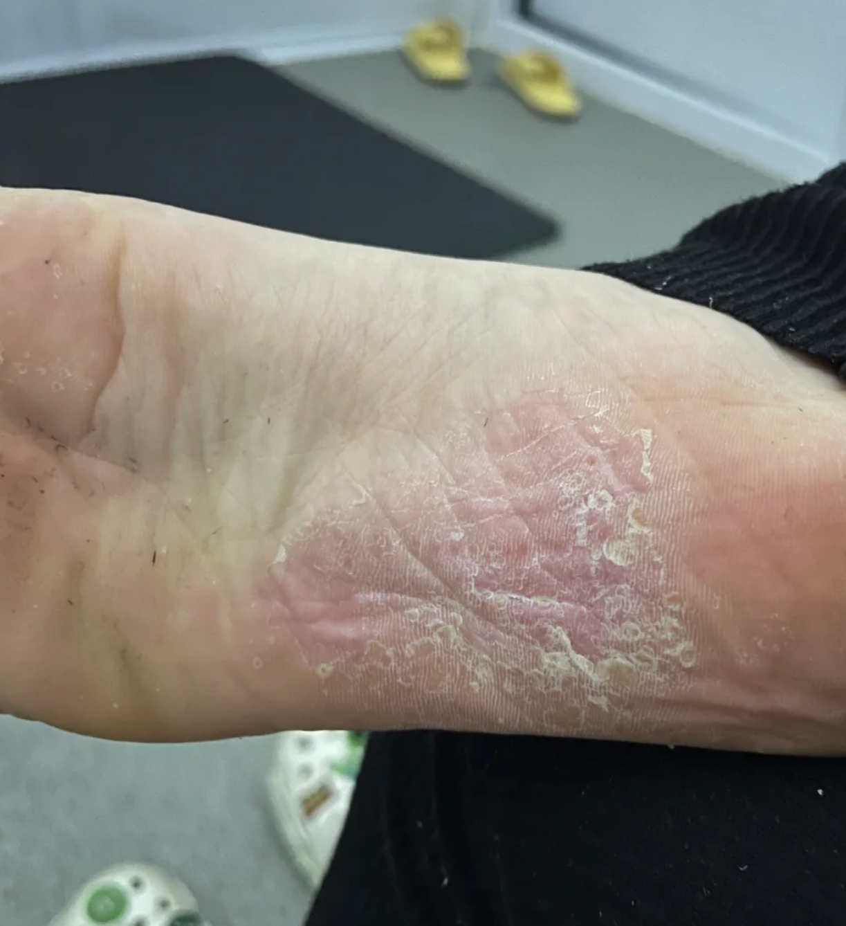 脚气就是足癣,它是由真菌感染引起的皮肤病,常见的致病菌有红色毛癣菌