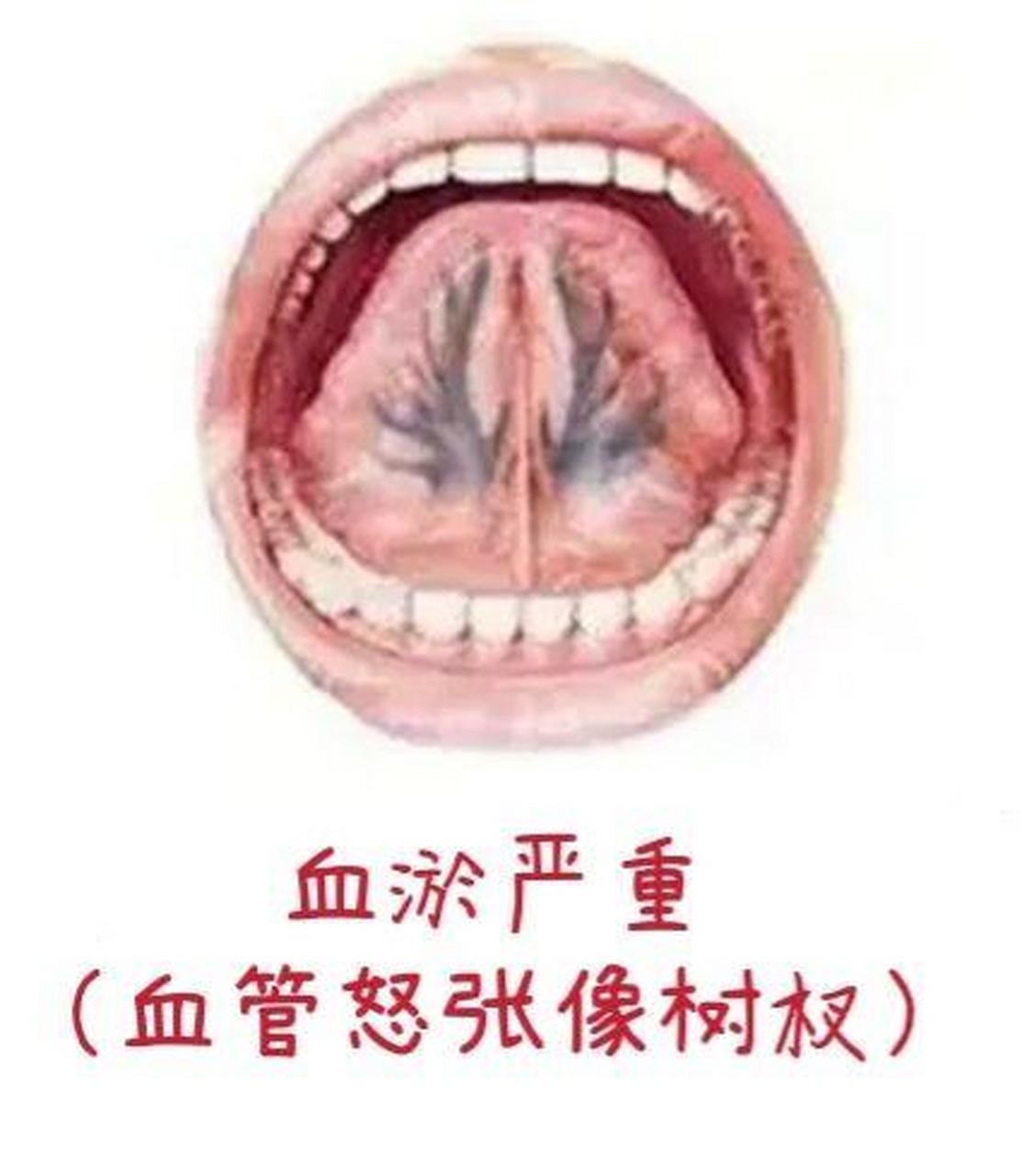 26岁宝妈三个月才来一次月经,一看舌下青筋粗大!你也有类似情况吗?