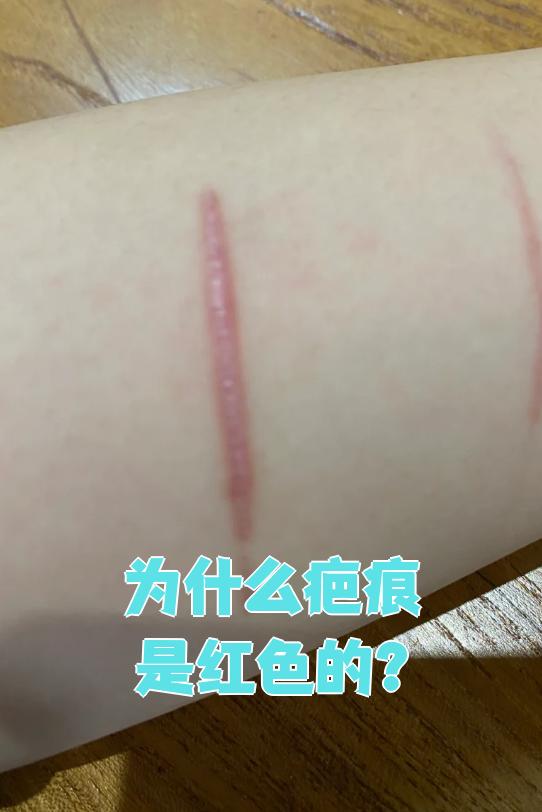 伤口为什么会疤痕增生