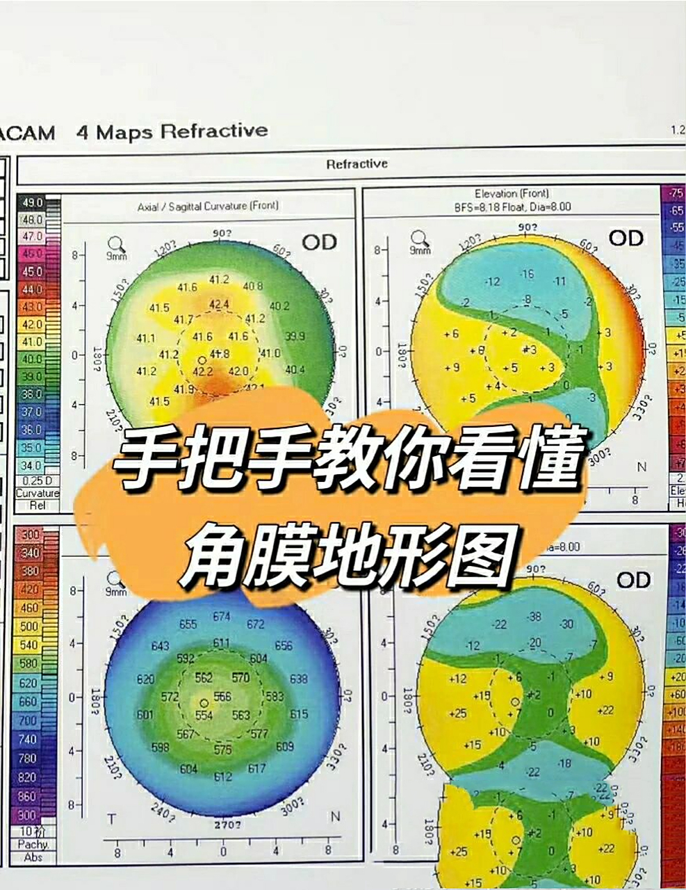 手把手教你看懂角膜地形图!
